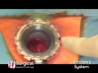 Chirurgie des hémorroïdes en ambulatoire