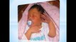 Jaundice In Newborns - Newborn Babies Symptoms & Treatment