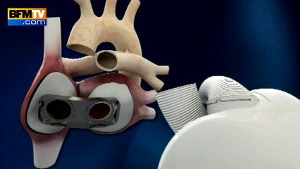Cœur artificiel: un troisième patient greffé