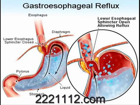 GASTROESOPHAGEAL REFLUX DISEASE