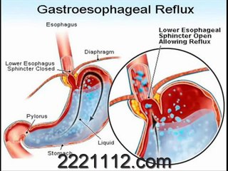 GASTROESOPHAGEAL REFLUX DISEASE