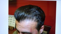 Fantastic Dense Man Hair Loss Transplant Hairline Restoration Surgery 1 Yr Follow Up Dr. Diep www.mhtaclinic.com