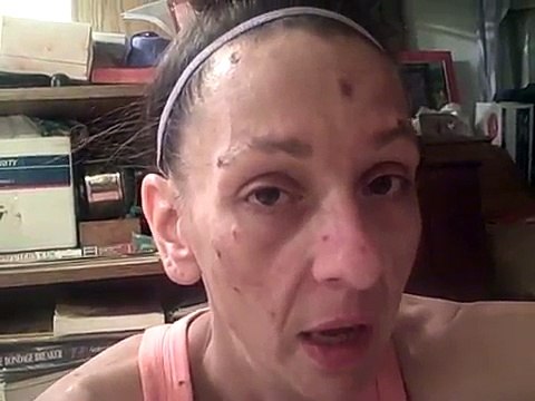 Face of Morgellons Disease - Getting the parasites to leave your skin within minutes!