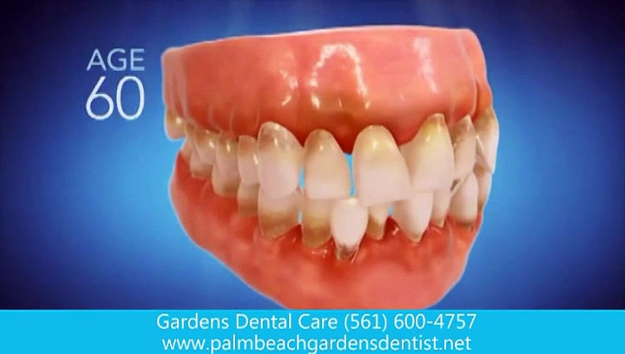 Invisalign Dentist Palm Beach Gardens, FL , Clear Braces