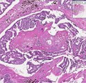 Histopathology Breast--Ductal carcinoma in situ