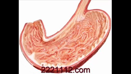 STOMACH_ PEPTIC ULCER -  اردو