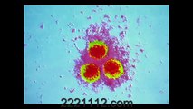 VARICELLA ZOSTER VIRUS -  اردو