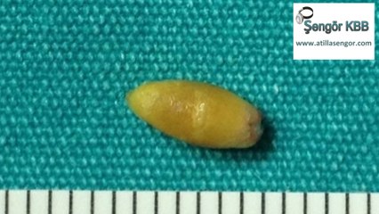 Salivary gland stone fragmentation and removal with sialendoscopy