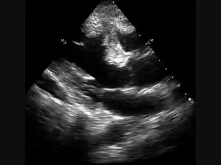 Regional wall motion abnormalities: Echocardiography