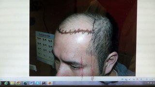 Excellent Man Hairline Transplant Treatment Before After Photos Dr. Diep www.mhtaclinic.com 1  Yr Follow Up