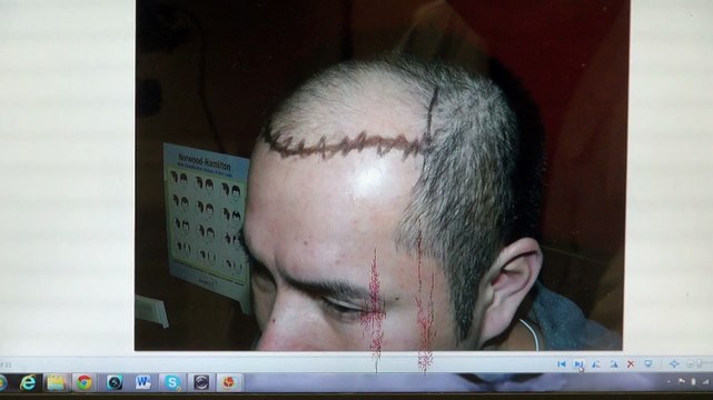 Excellent Man Hairline Transplant Treatment Before After Photos Dr. Diep mhtaclinic.com 1 Yr Follow Up