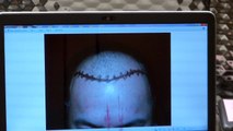 Bald Hair Loss Man Hairline Transplant Surgery 12 Months Follow Up Result Dr. Diep www.mhtaclinic.com