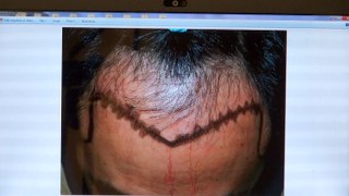 Man Hairline Restoration Transplant Dr. Diep www.mhtaclinic.com 12 Months Follow Up Result Before After Photos