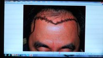 Fantastic Male Hair Transplant 1 Yr Result Before After Photos Dr. Diep www.mhtaclinic.com