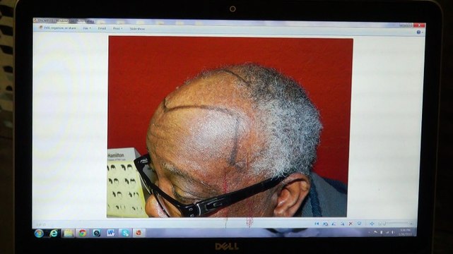African American Hairline Restoration Surgery 1 Yr Follow Up Result Before After Photos Dr. Diep mhtaclinic.com