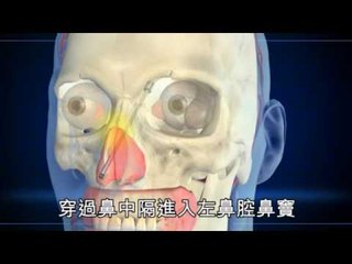 NMA 2010.03.31 動新聞  天線插鼻9個月 老翁險死