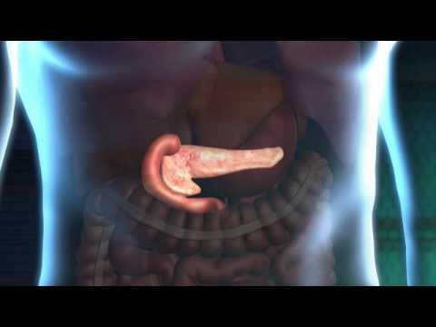 2010.02.03《Action news》Surgery hope for diabetes patients