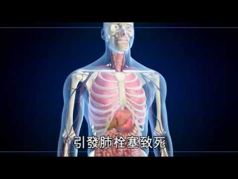 NMA 2009.12.18 動新聞 靜脈曲張 泡湯捉癢血染池水