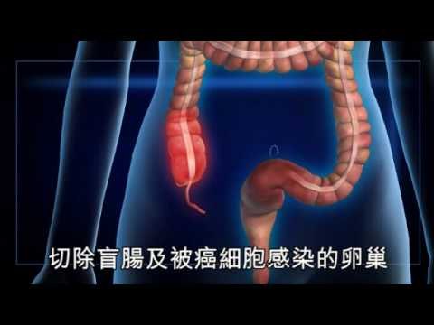NMA 2009.12.17 動新聞 腰背痠痛 竟罹患盲腸腺癌