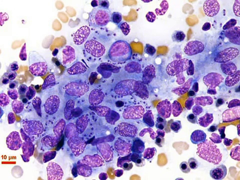 Mystery Diagnosis - Leishmaniasis