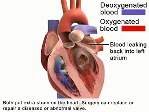 Heart valve surgery - operation for replacement heart valves