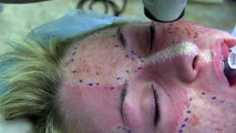 Deep FX and Active FX Laser for Acne Scars by Dr. Joe Niamtu, III