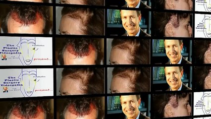 ADVANCES IN AESTHETIC AND RECONSTRUCTIVE HAIR RESTORATION by Alfonso BARRERA