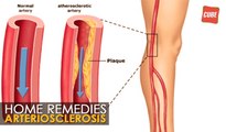 Arteriosclerosis Treatment - Home Remedies | Health Tips