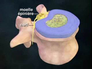 L'Hernie discale