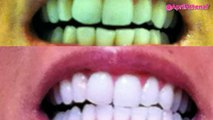 My TEETH (Before & After) Invisalign, Zoom Teeth Whitening, Veneers