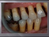 LANAP Laser Periodontist Lecture Before and After Pictures X-Rays & CT scans