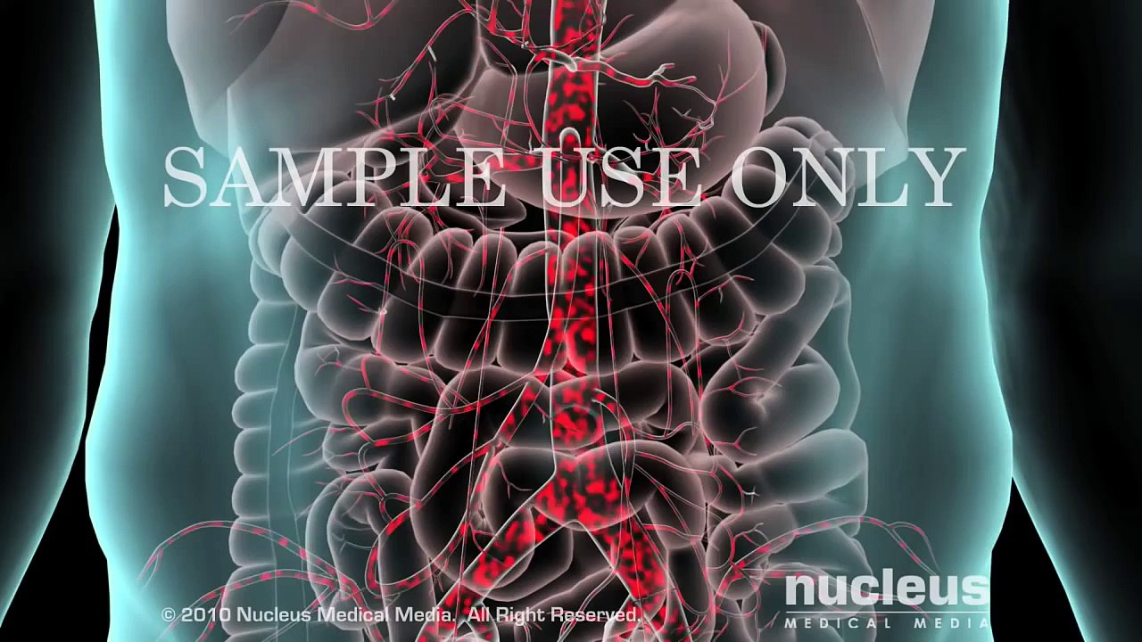 Abdominal Aortic Aneurysm