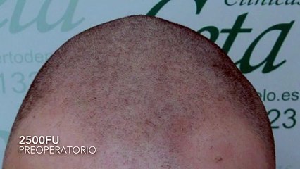 CLINICAS CETA CAPITAL www.injertodepelo.es