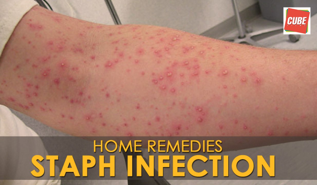 Staph Infection Treatment - Home Remedies | Health Tips