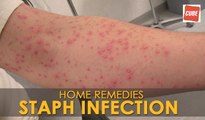 Staph Infection Treatment - Home Remedies | Health Tips