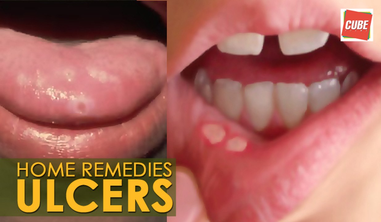 Ulcers Treatment - Home Remedies | Health Tips
