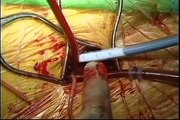 Right Thoracotomy Approach For Minimally Invasive Mitral Valve Surgery