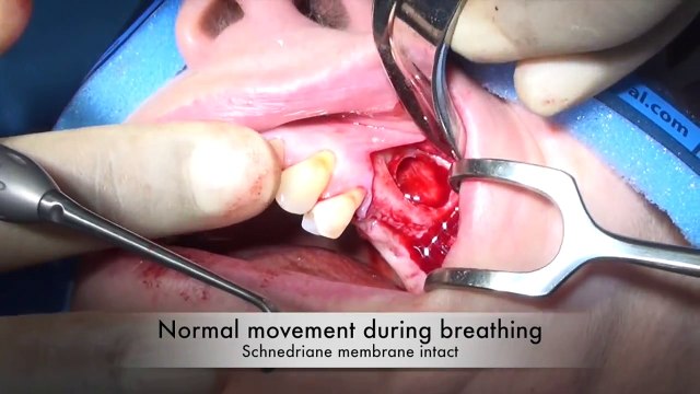 Maxillary Sinus lift Lateral Window. Kuljeet MEHTA-Periodontist. www:kmperio.co.uk