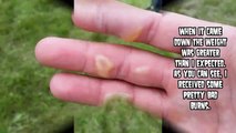 World's Worst Blisters, Burns and Cysts - Rope Burn Story