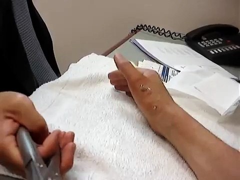 3 Pins being removed from right thumb