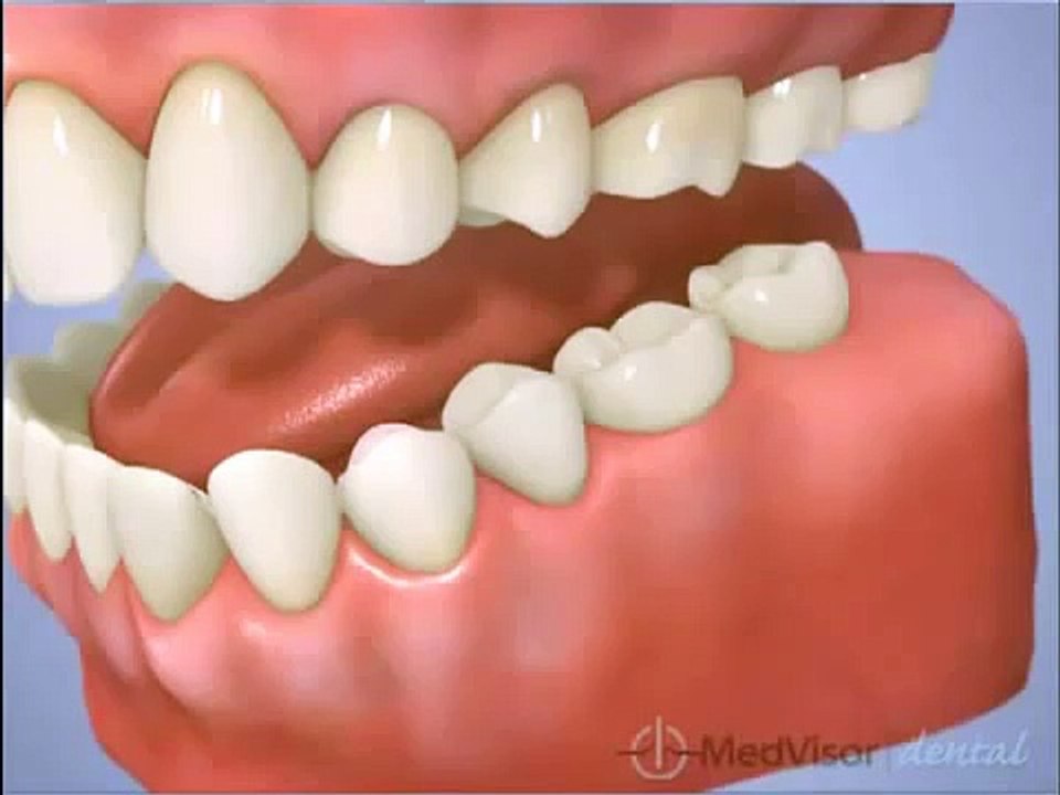 Bridges vs. implants_ what will work for your budget