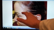 Woman Bald With Receding Hairline Transplant Restoration Surgery Dr. Diep www.mhtaclinic.com 1 Year Follow Up Result