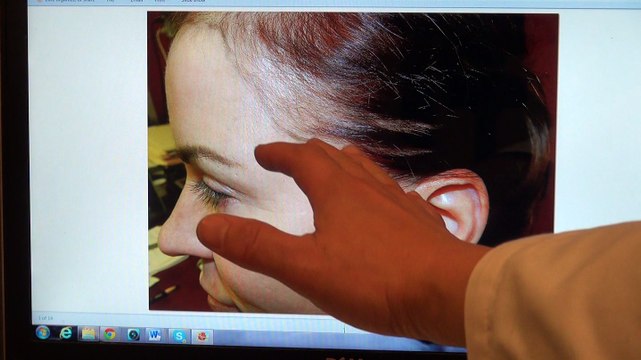Woman Bald With Receding Hairline Transplant Restoration Surgery Dr. Diep mhtaclinic.com 1 Year Follow Up Result