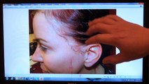 Woman Hair Loss Transplant Restoration Surgery Dr. Diep www.mhtaclinic.com 12 Months Follow Up Result