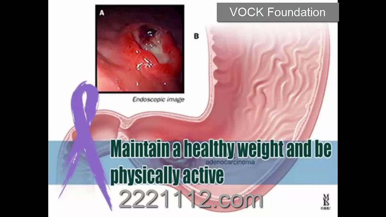 Stomach Cancer