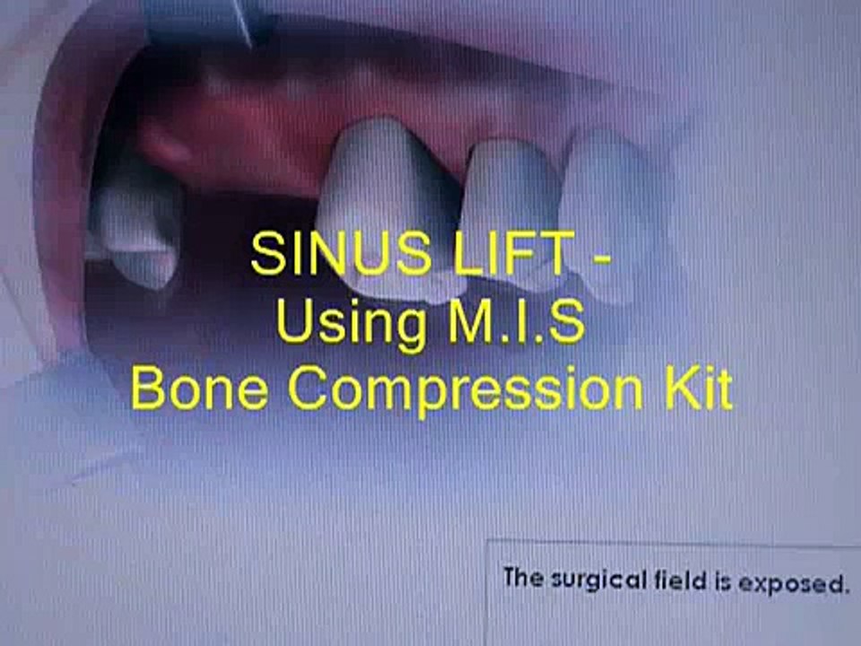 Sinus lift video :using MIS-Implants Bone compression kit