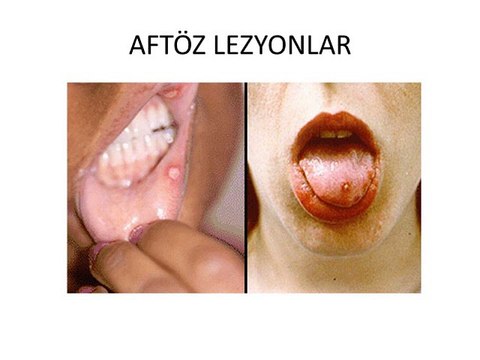 behçet hastalığı danışma 0535 3573503,behçet hastalığı tedavisi,behçet hastalığı,behçet hastalığı kök hücre ile tedavisi