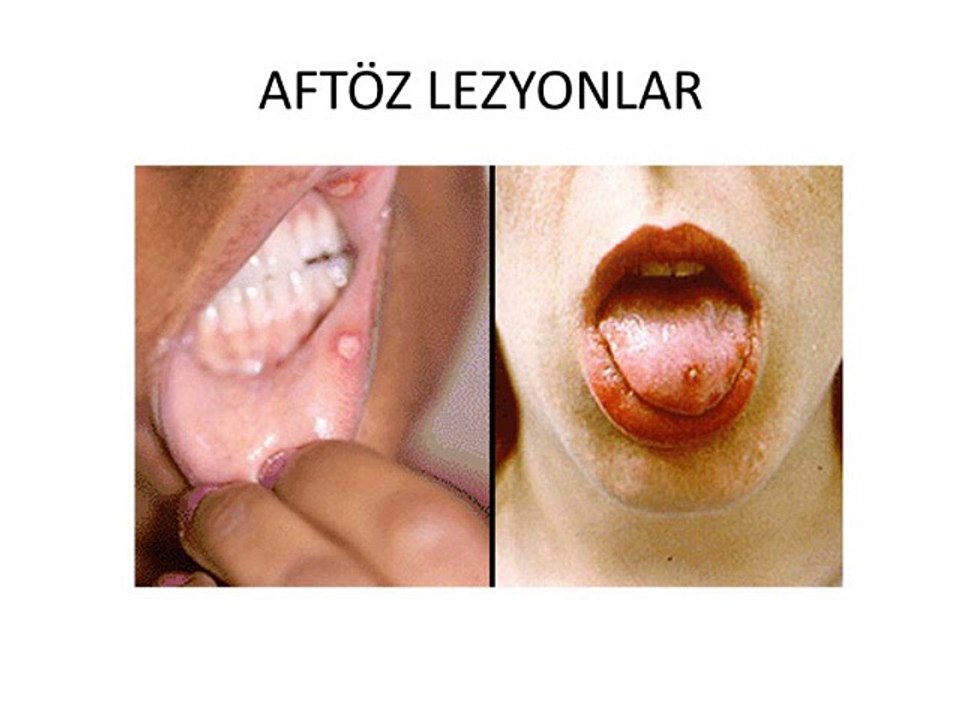 behçet hastalığı danışma 0535 3573503,behçet hastalığı tedavisi,behçet hastalığı,behçet hastalığı kök hücre ile tedavisi