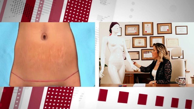 Op.Dr.Defne Erkara - Karın Germe Ameliyatı Hangi Durumlarda Uygulanır?