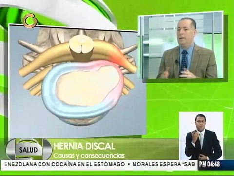 90% de los pacientes que son operados por hernias discales son dados de altas al día siguiente